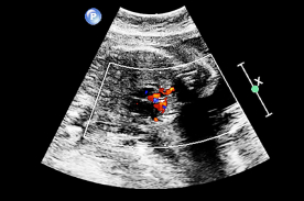 Cardiopatia