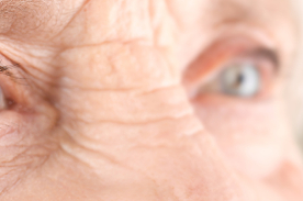 Glaucoma
